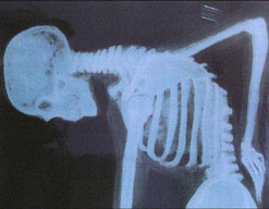 an exray showing a skeleton bent over in pain with a hand over their lower back